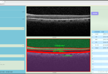【完整源码+数据集+部署教程】眼底图像层次分割系统源码和数据集：改进yolo11-DCNV3-网硕互联帮助中心