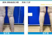 静脉曲张没有绝对 “最好” 的治疗方法，对症下药最重要-网硕互联帮助中心